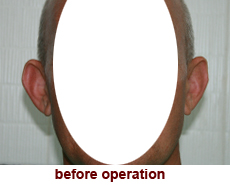 plastic-surgery-prominent-ear 